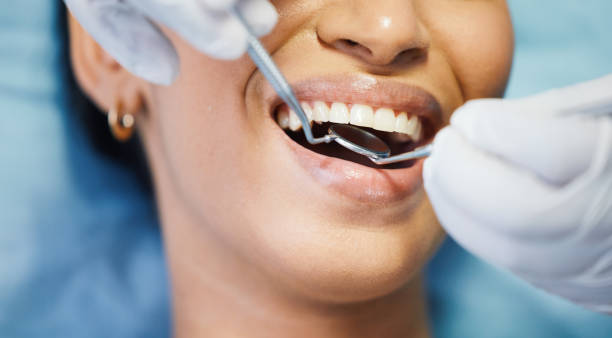 Teeth Whitening in MS